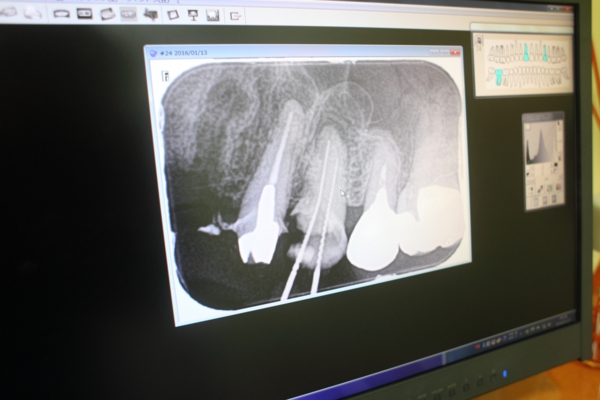 デジタルレントゲンはすぐに処理され画面上で詳しく診査されます。