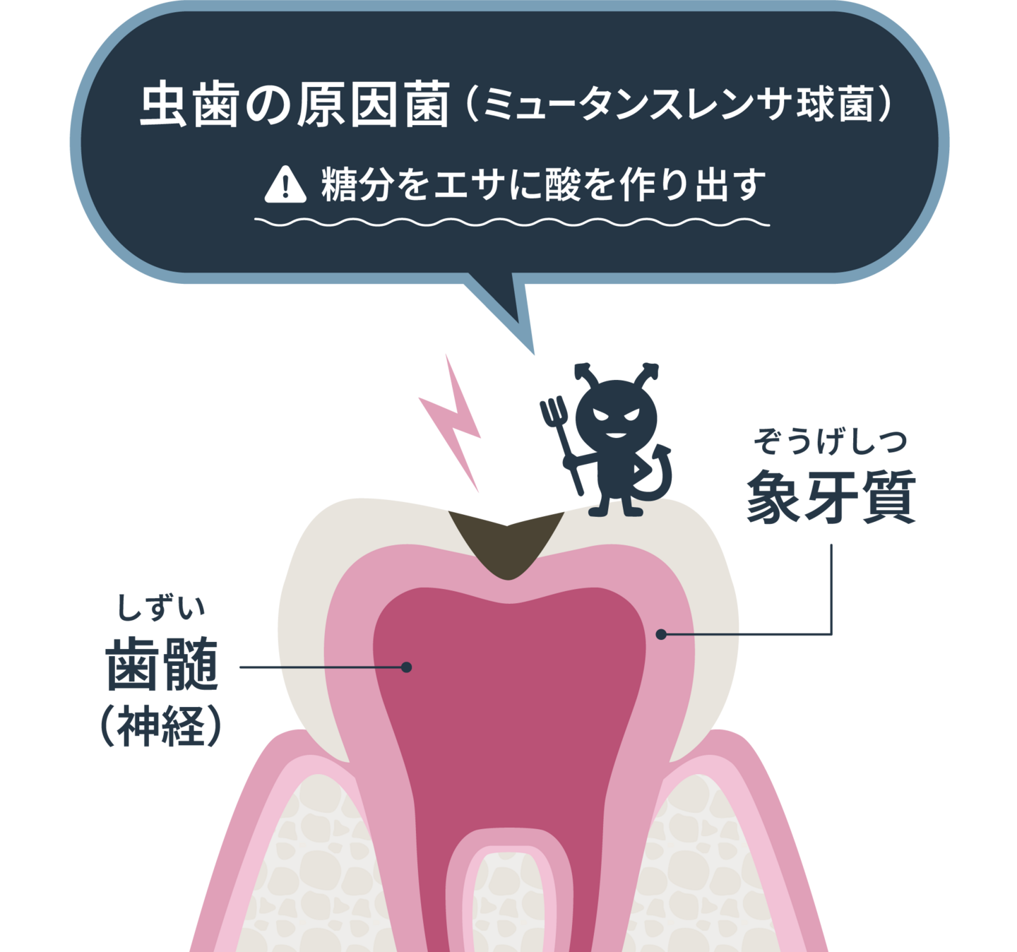 虫歯の仕組みイラスト