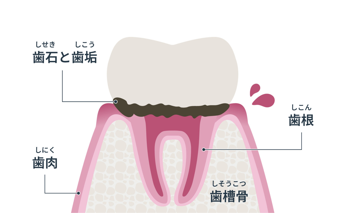 歯周病の仕組みイラスト